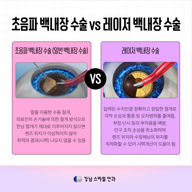 必须比较后选择的江南站白内障手术方法