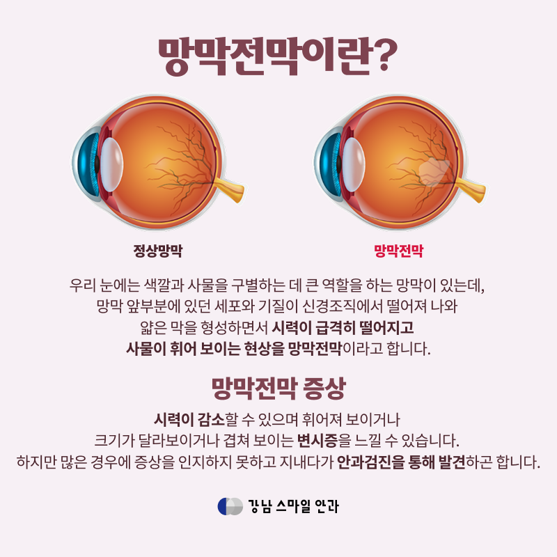 Gangnam Station Presbyopia Treatment: Blurred Vision Without Cataracts? Distinguish It From ‘This’!