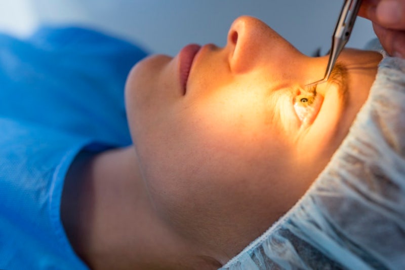 Urutan Operasi LASIK dan Kelopak Mata Ganda, Mana yang Duluan?