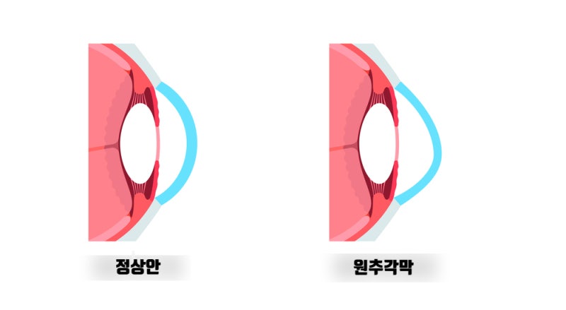 If LASIK/LASEK is difficult? ICL that preserves the cornea | Best ICL Surgery Clinic