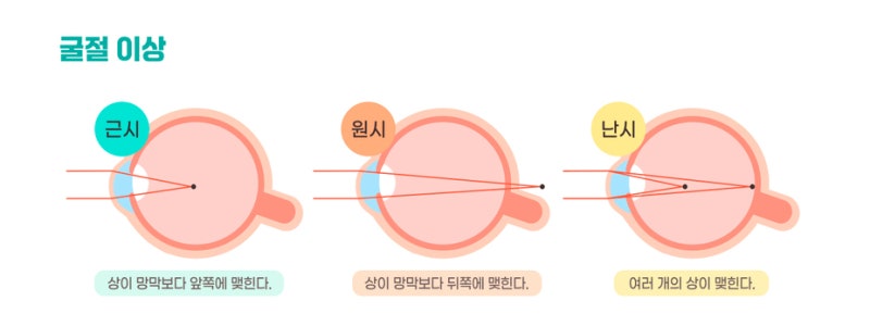 스마트노바라식, 스마일라식과 무엇이 다를까? 난시 교정부터 각막절삭까지 사진 2