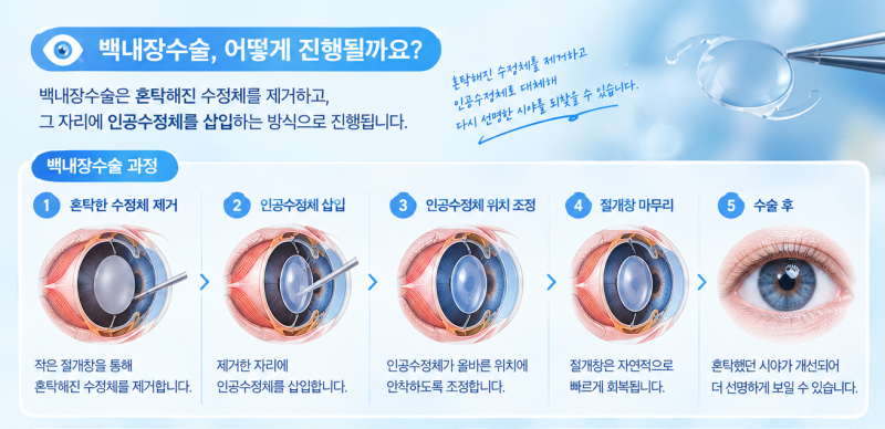 강남백내장수술 전 알아두면 좋은, 눈의 자동 초점 원리