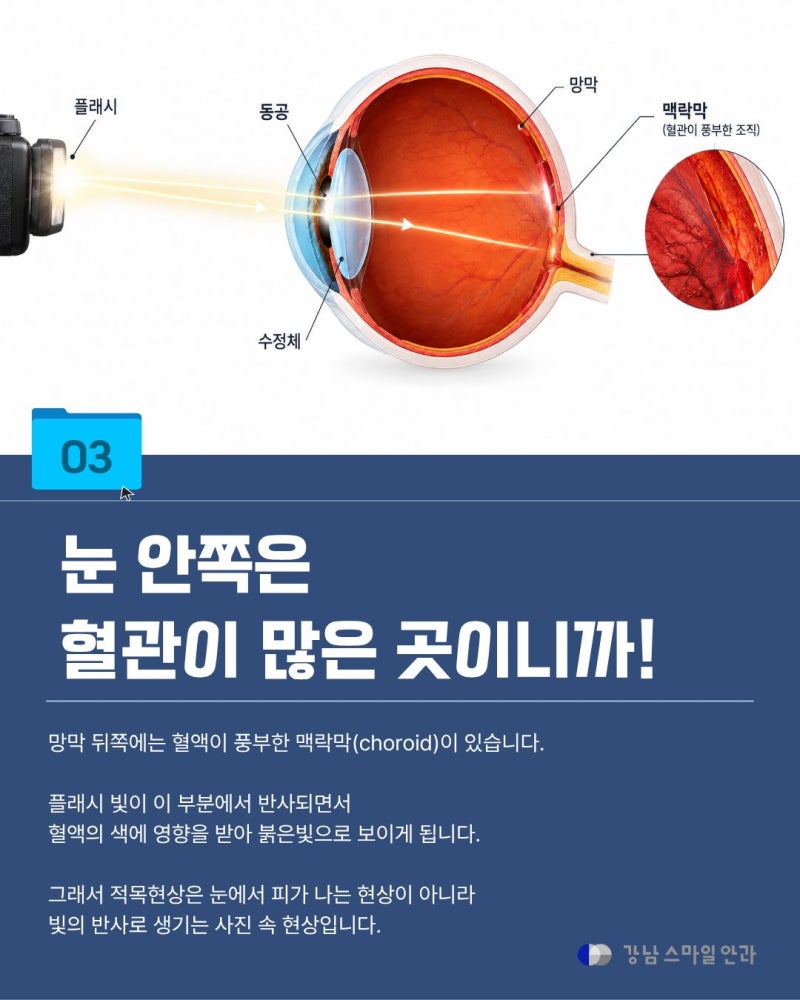 [강남역안과] 사진 찍으면 왜 눈이 빨갛게 나올까? 적목현상의 원리와 주의할 점 사진 4