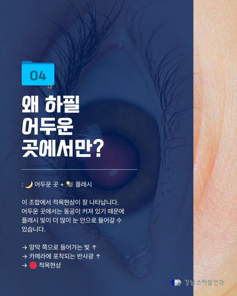 [강남역안과] 사진 찍으면 왜 눈이 빨갛게 나올까? 적목현상의 원리와 주의할 점 사진 5