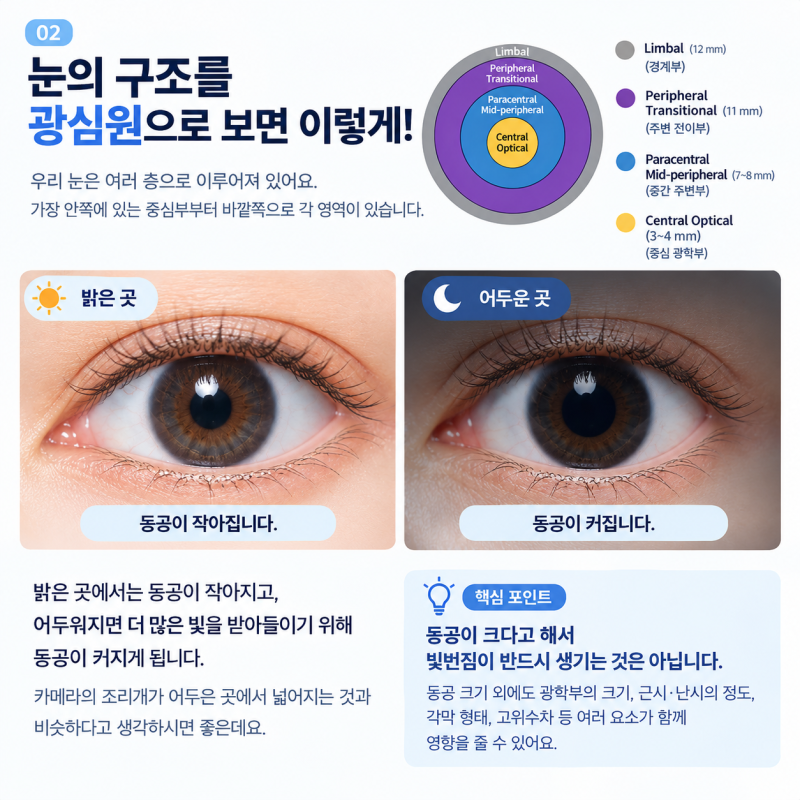 Gangnam Station 2-Day LASEK: 3 Essential Things to Know if You Have Large Pupils 사진 2