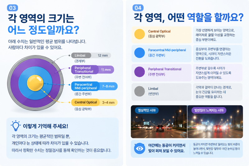 Gangnam Station 2-Day LASEK: 3 Essential Things to Know if You Have Large Pupils