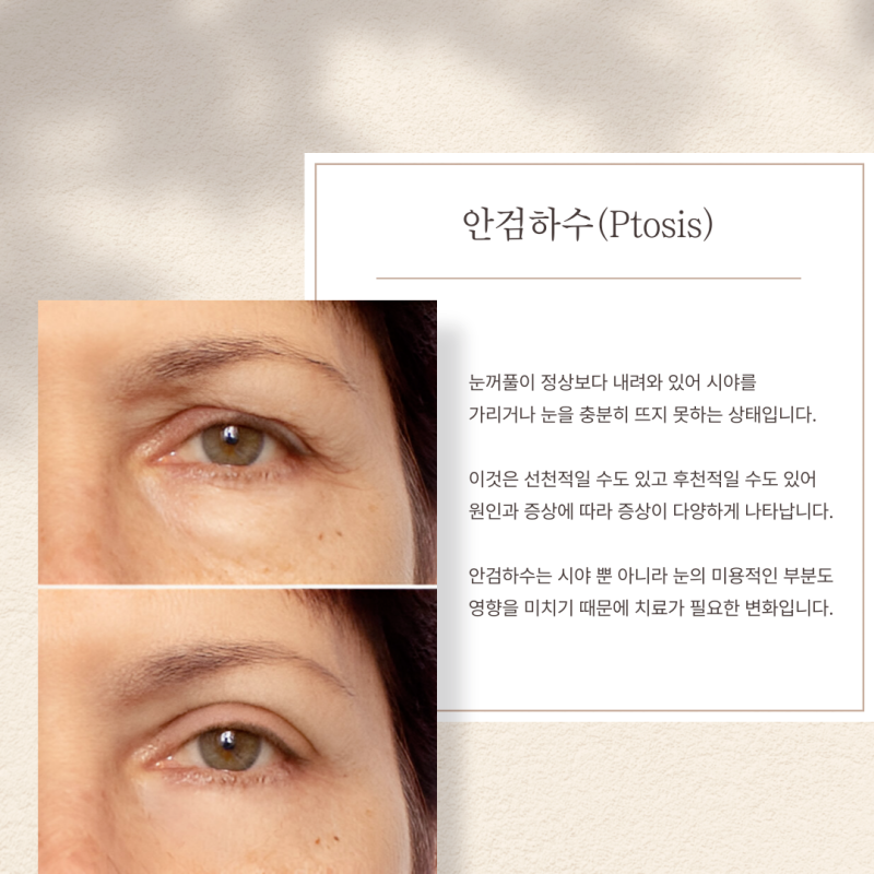 안검하수 수술 실패로 재수술 해야 할 때 압구정로데오성형외과
