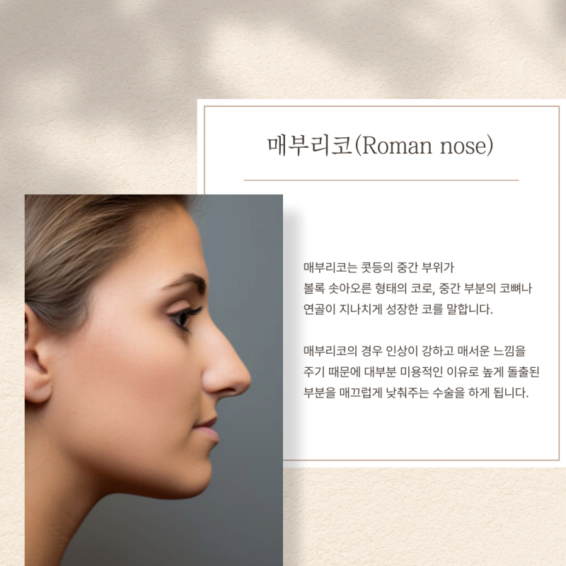 매부리코 자가교정보다 수술은 청담역성형외과에서
