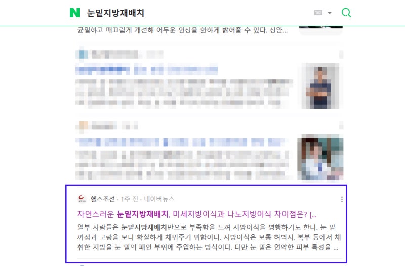 [헬스조선] 자연스러운 눈밑지방재배치, 미세지방이식과 나노지방이식 차이