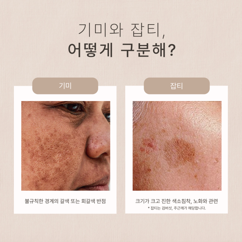 청담동피부과잘하는곳 기미잡티 레이저로 말끔하게 제거될까