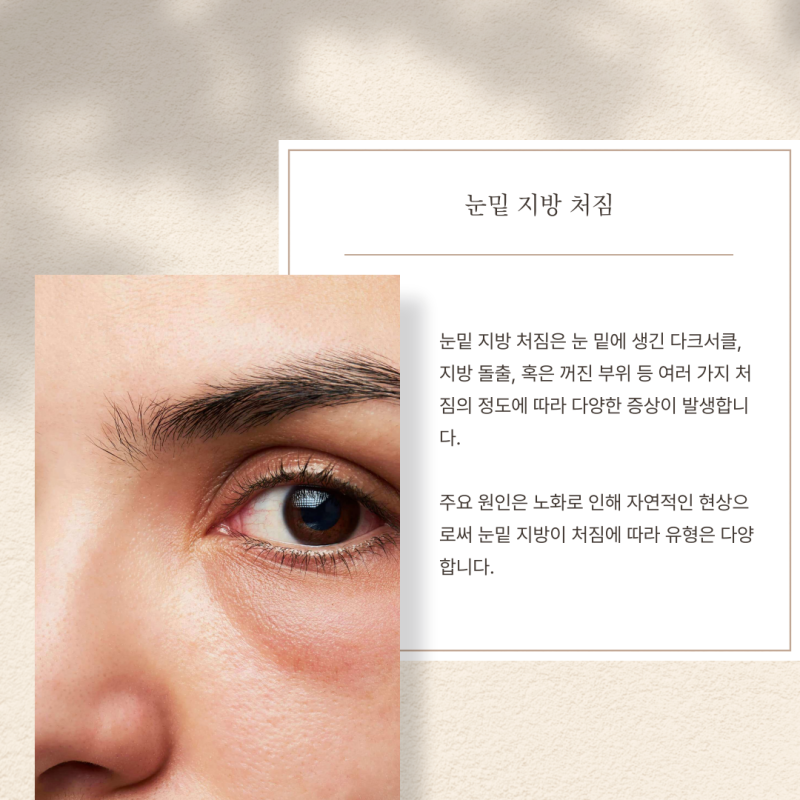 청담동 눈성형 눈밑 주름 없애는 방법은?