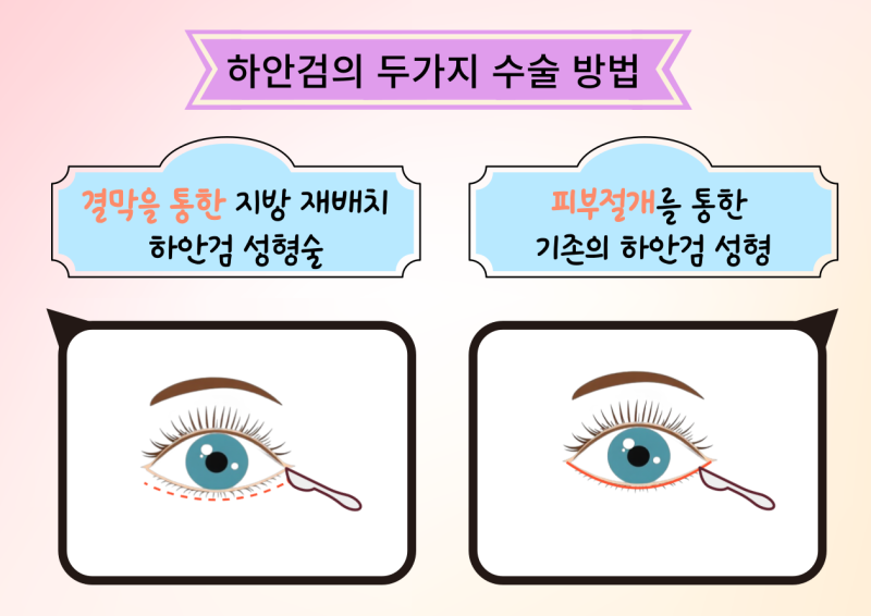 하안검 성형술: 지방 재배치 VS 피부절개 방법 중 어떤 것을 선택해야 하나?