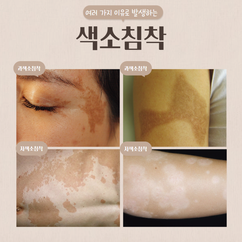 청담역피부과 피부에 얼룩 생겼을때 필요한 시술