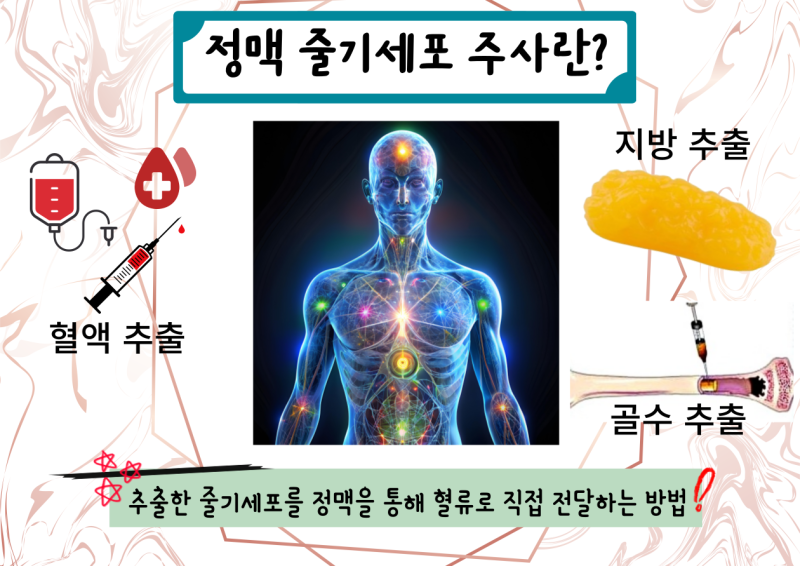 정맥 줄기세포 주사의 장단점