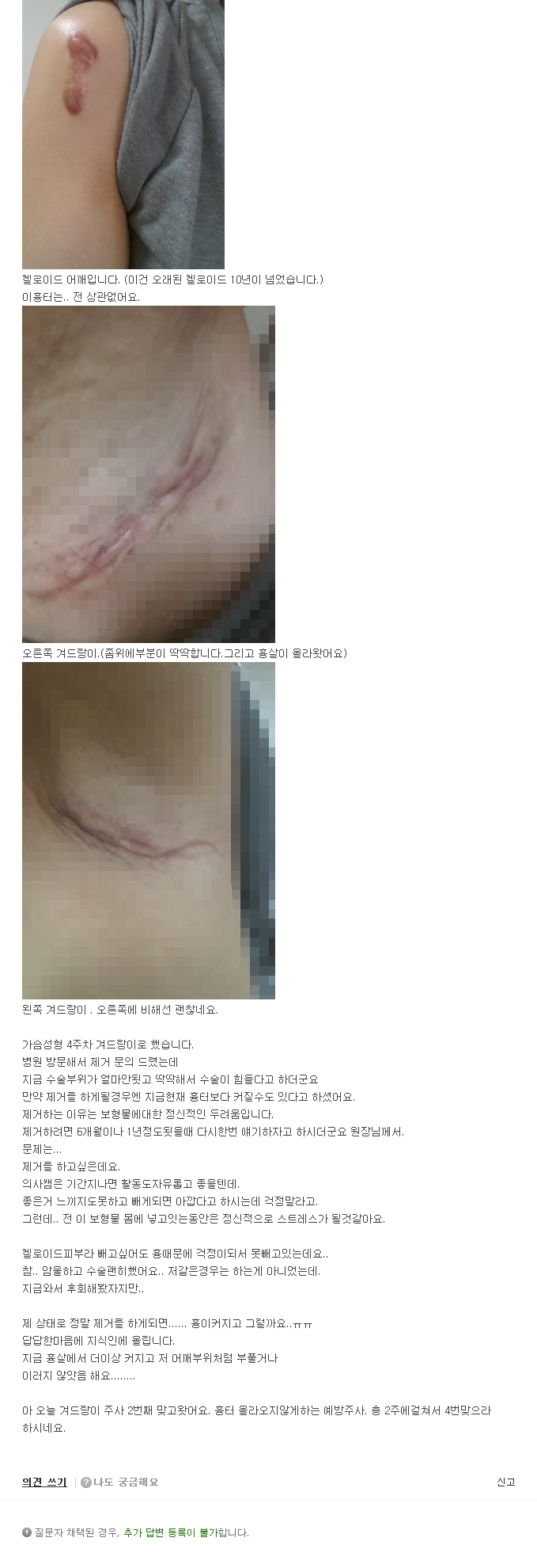 [NAVER 지식iN] 켈로이드성피부 가슴보형물제거문의.