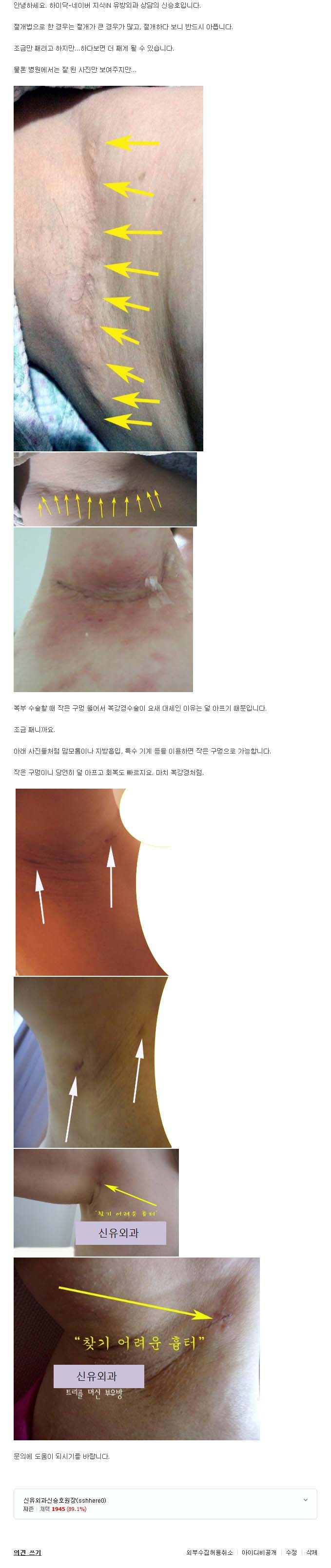 [NAVER 지식iN] 부유방제거수술 흉터 어느 정도 인가요?(부유방흉터, 찾기 어려운 흉터) 