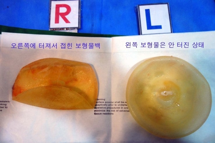 2015.1.28. 가슴보형물제거수술을 겨드랑이로 뺐는데도 부분마취만으로 하고 바로 내려가신 분. 