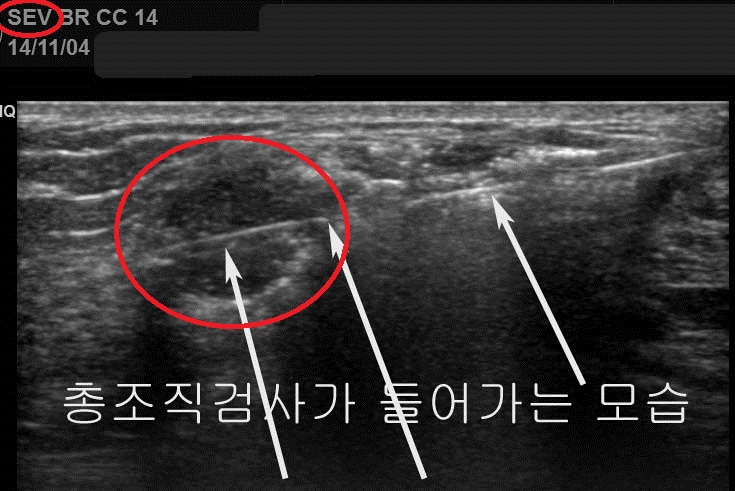숨겨지는 작은 구멍 "감쪽같은 맘모톰수술" : 여러 개의 멍울도 단 하나의 구멍으로 하루에 제거!