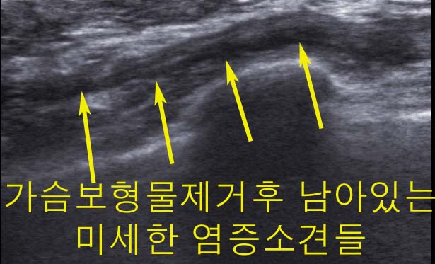 물방울가슴성형수술부작용으로 염증생겨서 가슴보형물제거수술을 받았으나 여전히 염증이 남아 있어서 불편해 하셨던 분. 