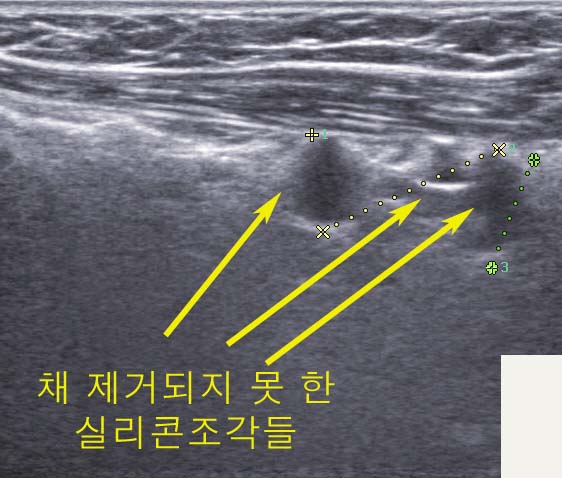 가슴성형실리콘보형물파손으로 제거한 후 코젤로 교체한 타병원에서 수술받으신 분 : 아쉽게도 조금 남아있는 잔존물들