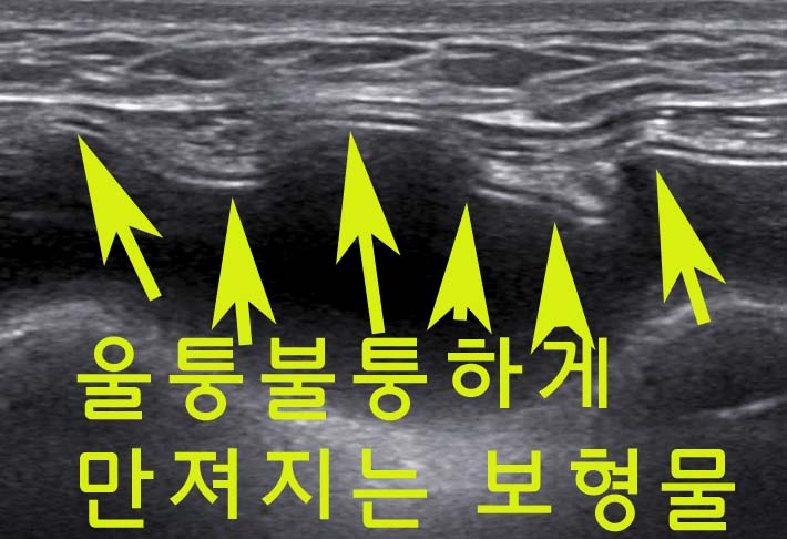 가슴성형보형물이 있는 상태에서도, 2cm크기의 유방멍울이 맘모톰수술로서 안전하게 제거된 분. 