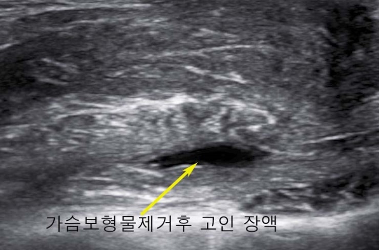 타원에서 가슴보형물제거수술후 A/S로서 유방초음파검사를 하지 않아 고여있는 장액을 제거하지 못 한 경우