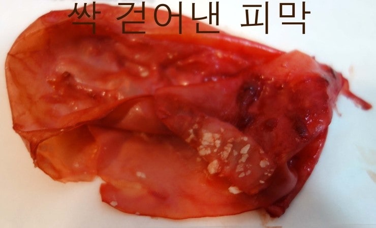 가슴성형보형물파손이 너무 심하고 오래되어서 보형물을 감싼 피막캡슐까지도 싹 다 제거한 (강남)신유외과 환자분.