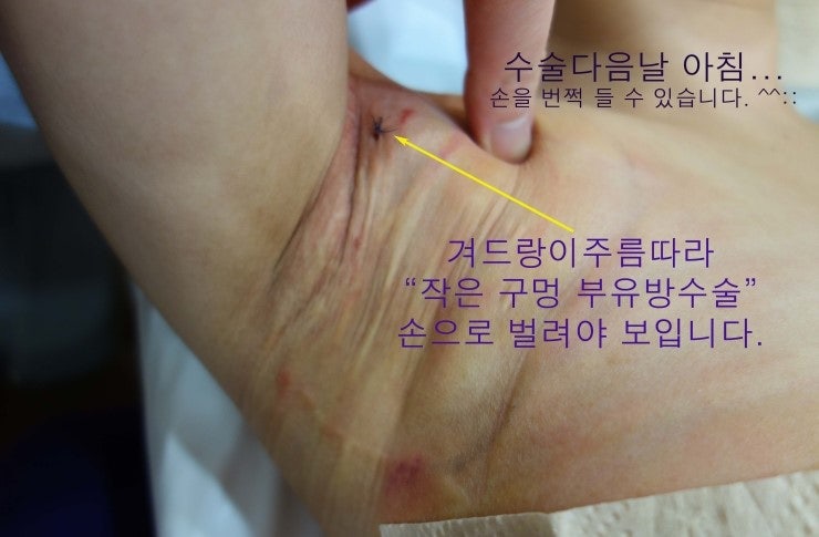 2015년 2월 부유방제거수술받으신 분의 겨드랑이부유방제거수술후기입니다. :오직 작은 구멍 하나로만 유선&지방조직제거