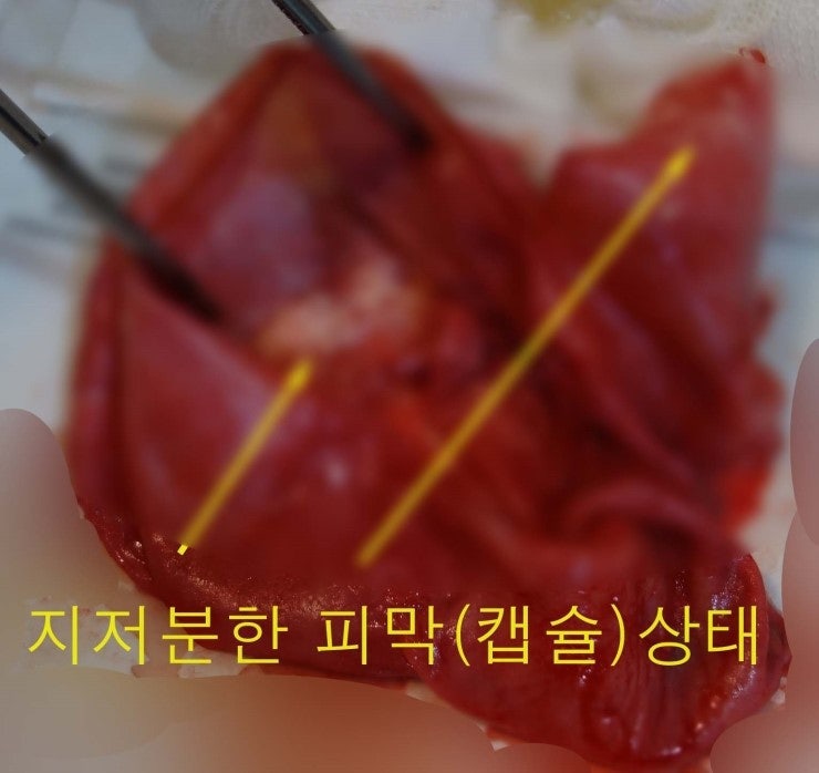 가슴성형보형물제거수술의 어려운 예 후기 ; 가슴보형물파손이 겨드랑이큰혈관을 침범하기 직전이었던 환자분.