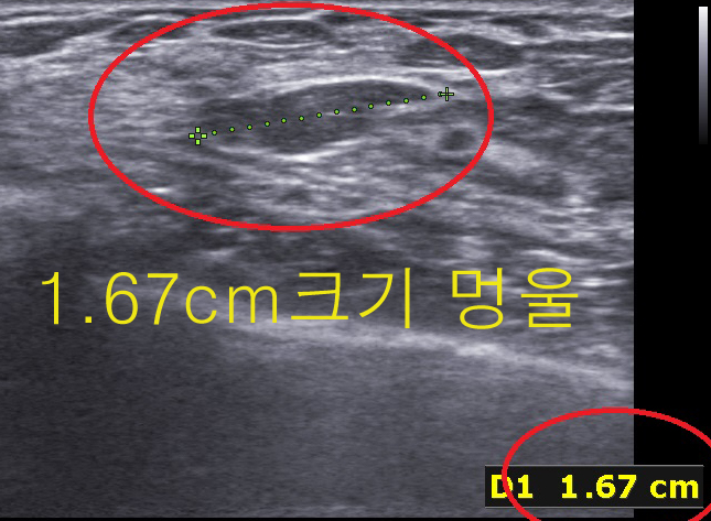 겨드랑이로 맘모톰수술을 한다고요? 정말 가능할까요?