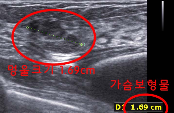 물방울가슴성형보형물맘모톰수술의 끝은 어디인가 : 가슴멍울과 가슴보형물사이에 안전거리 확보후 안전하게 시행된 가슴보형물맘모톰수술.