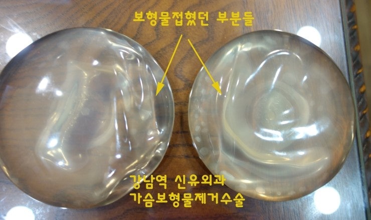 가슴보형물제거수술후기입니다. : 유륜절개로 "부분마취"만으로 쉽게 제거된 케이스입니다. 