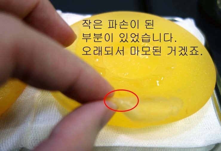 ☆ 가슴보형물파손되어 제거수술한 후기입니다. ; 하이드로겔가슴보형물파손제거수술 ☆ 