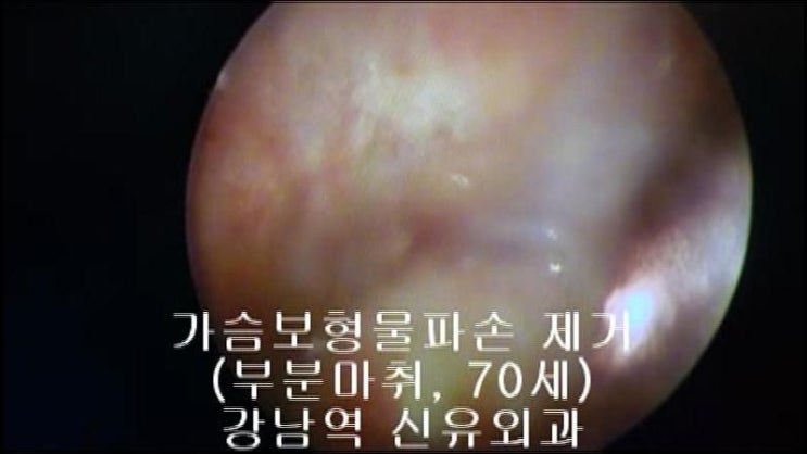 70세 고령 : "부분마취"로만 가슴보형물파손제거수술후기입니다. 