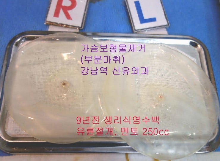 9년전 넣은 생리식염수백을 유륜 부분마취만으로 <가슴보형물제거 받으신 분의 수술후기>.