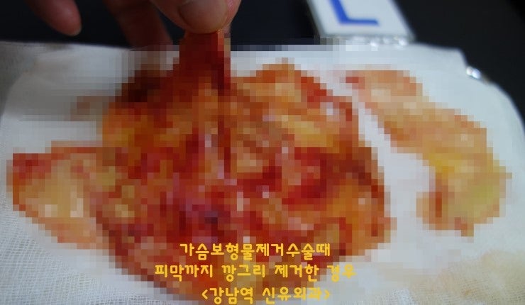 가슴보형물 제거상담.(하이드로겔파손 vs 실리콘가슴보형물파손 vs 코헤시브겔파손) 