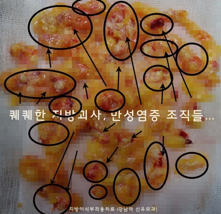 1년전 2차까지 자가지방가슴이식성형수술을 받으신 후 양쪽 가슴통증으로 부작용치료 받으신 분의 가슴지방이식부작용치료수술후기입니다.