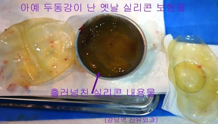 69세 고령이신데 옛날 가슴실리콘보형물파손 ; 부분마취만으로 완벽 제거된 분의 가슴보형물제거수술후기.