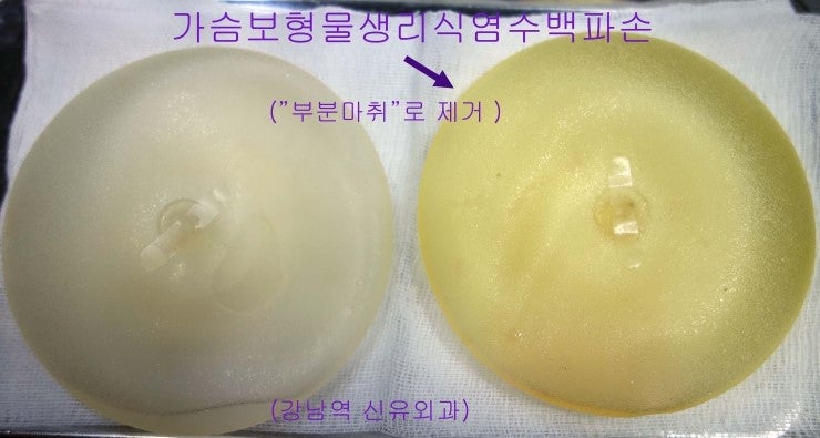 12년전 넣은 가슴생리식염수백이 파손되어 부분마취만 하고 간결하게 가슴보형물제거수술을 받으신 분의 후기