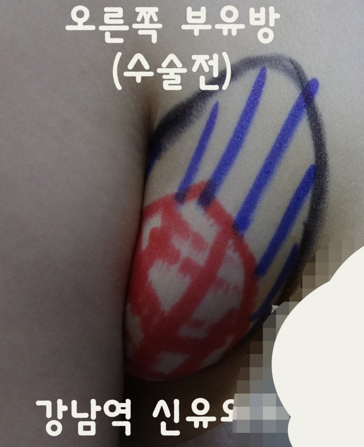 "부분마취"로만, 오직 작은 구멍 하나(0.7cm)로 시행된, 거대 부유방제거수술후기.