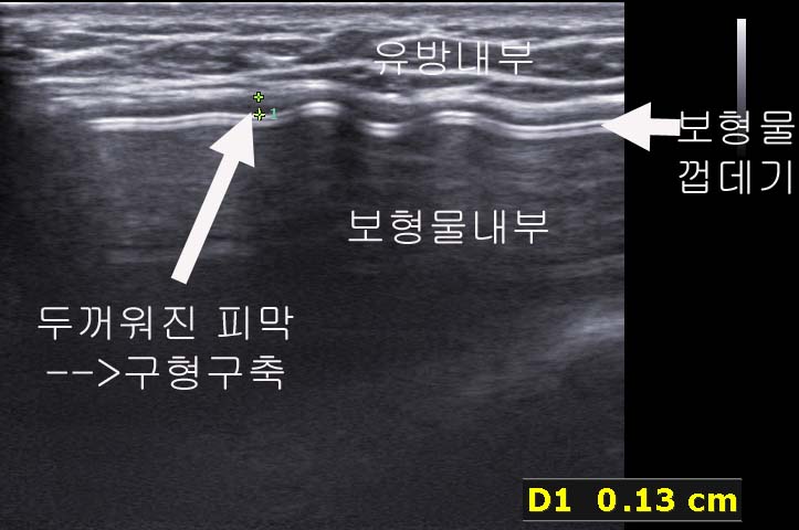 가슴성형수술후 부작용 : 구형구축을 유방초음파로 보고 피막의 두께를 측정하여 객관적으로 증명해야 합니다. 