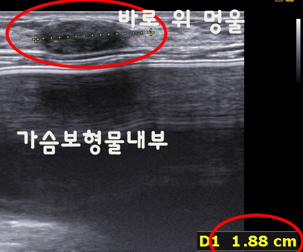 물방울가슴성형술 후 거대섬유선종멍울 : 맘모톰수술로 안전하게 제거