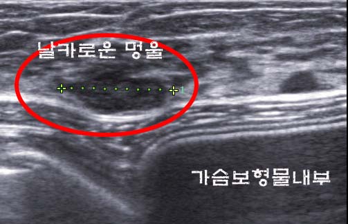물방울가슴성형후 맘모톰수술부작용? 함몰은 없었고 멍이 좀 들었습니다. ㅠㅠ