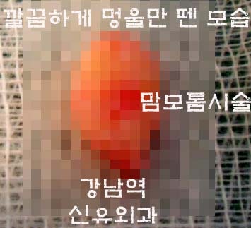 겨드랑이주름으로 들어가는 맘모톰수술후기 
