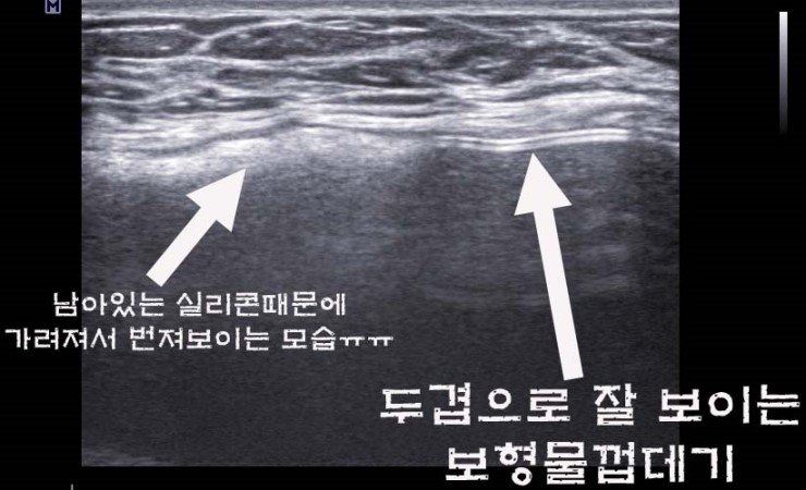 가슴실리콘팩파손되어 가슴성형재수술을 받으셨는데 완전제거가 안 되고 여기저기 실리콘이 남아서 흩어져 있던 분. 