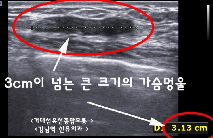 3cm이 넘는 거대 섬유선종도 맘모톰수술로 함몰되는 부작용없이 안전하게 제거됩니다. 