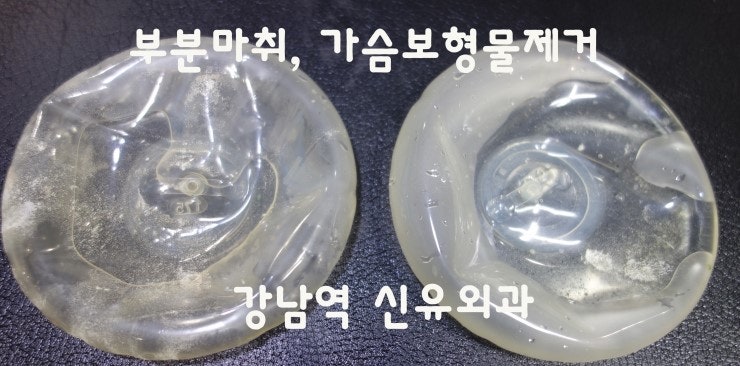 부분마취니까 가슴보형물제거수술을 받으시고 바로 내려가신 창원 마산에서 오신 분