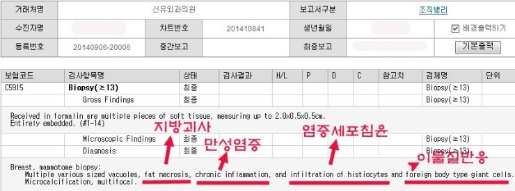 가슴지방이식성형수술후 1년반이 지나 석회화부작용생겨서 멍울이 만져져서 내원하셨는데, 실제로는 병변이 더 크고 많았습니다. 
