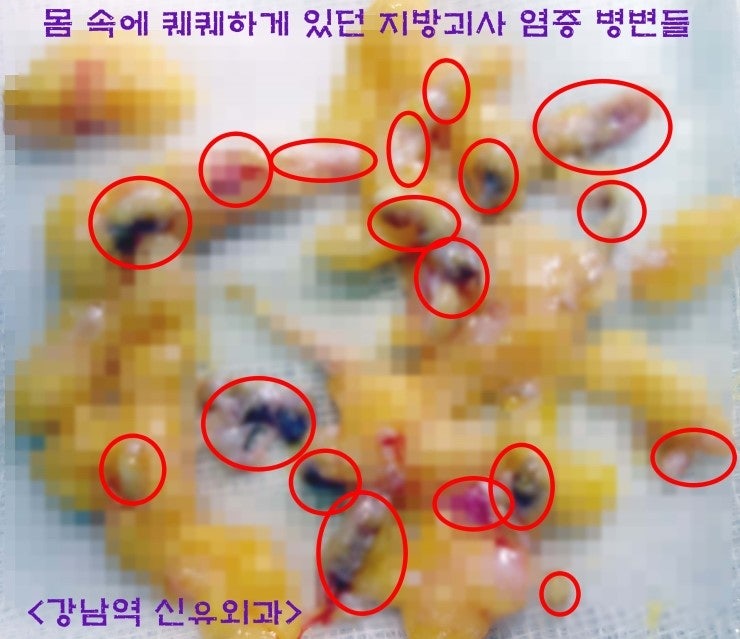 타 성형외과에서 의뢰되신 가슴지방이식부작용치료 환자분의 치료일지