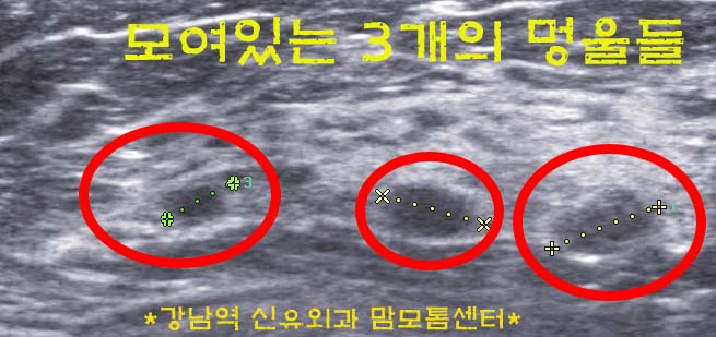 모여있는 세 개의 가슴멍울을 겨드랑이맘모톰수술로 한 번에 제거하고 함몰도 없었던 분.